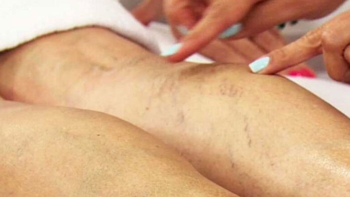 Varizes veias das extremidades inferiores
