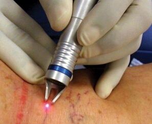 Como o tratamento a laser das varizes é realizado
