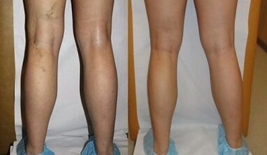 Tratamento a laser de varizes Photo antes e depois