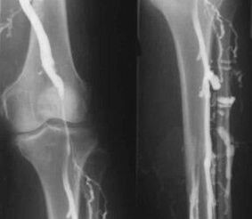 Opções de diagnóstico para varizes das extremidades