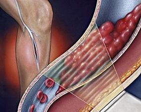 varizes das veias profundas das extremidades inferiores