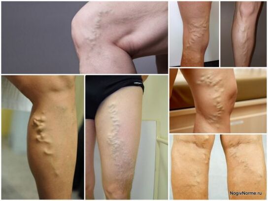O que são as varizes veias